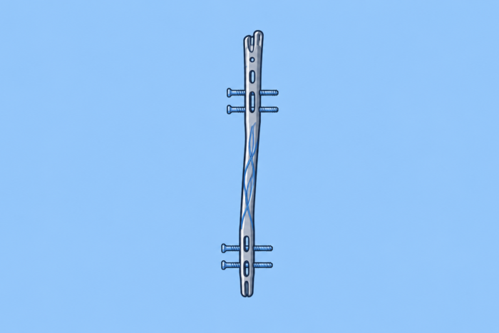 Meduloc Raises $4M Series B to Launch FDA-Cleared Fracture Fixation Platform